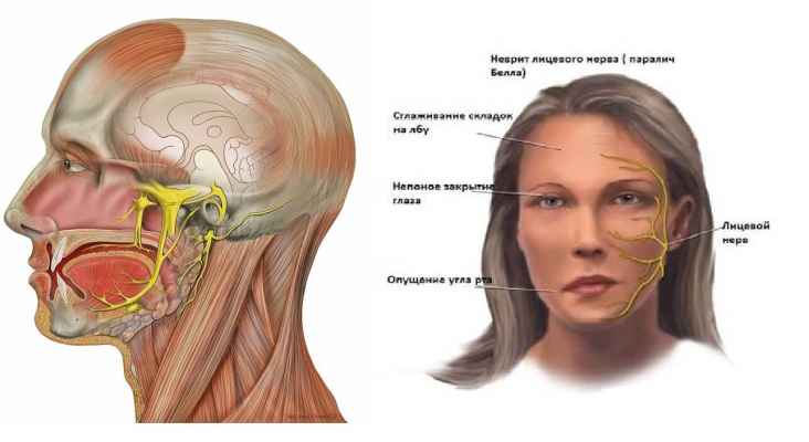 Неврит лицевого нерва передается по наследству